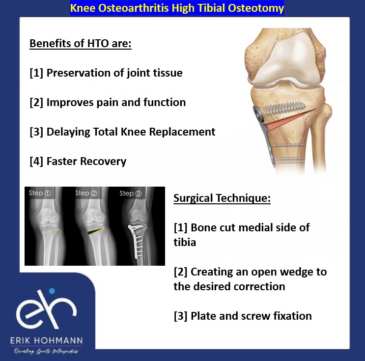 Knee Osteoarthritis High Tibial Osteotomy