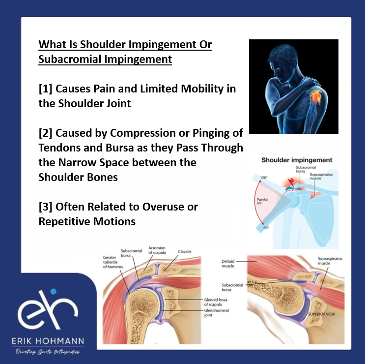What is Shoulder Impingement or Subacromial Impingement