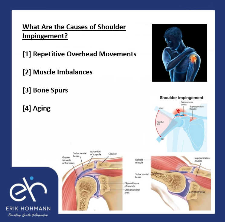 What are the causes of Shoulder Impingement?