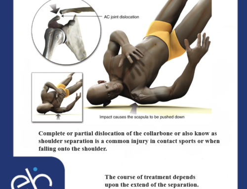 Complete or partial dislocation of the collarbone or also know as shoulder separation is a common injury in contact sports or when falling onto the shoulder.