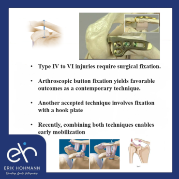 Type IV to VI injuries require surgical fixation | Fixation with hook plate