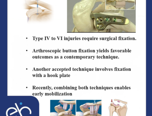 Type IV to VI injuries require surgical fixation | Fixation with hook plate
